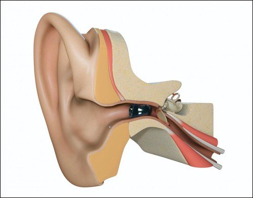 Внутриканальный слуховой аппарат