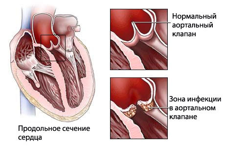 Поражение сердечных клапанов эндокардитом