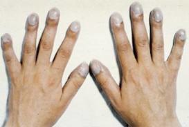Утолщение пальцев при эндокардите 