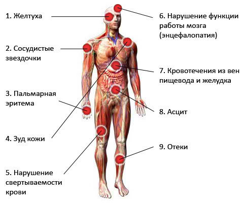 Симптомы цирроза