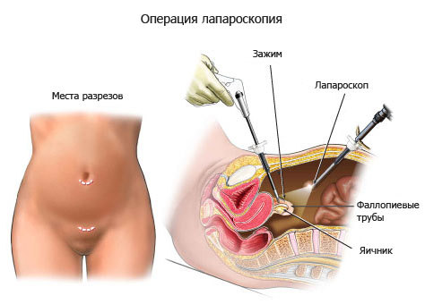 Диагностическая лапароскопия брюшной полости: показания и проведение процедуры