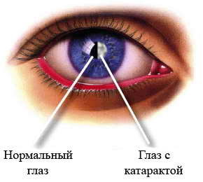 Диагностика катаракты 