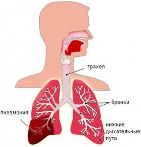 Хроническая пневмония