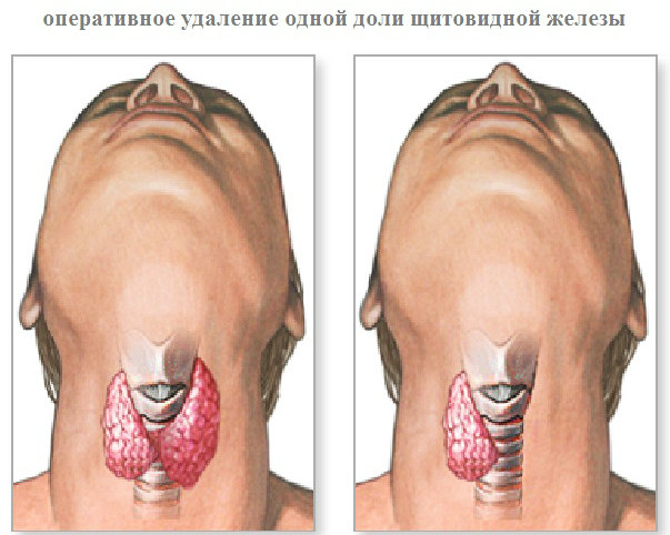 Оперативное удаление части щитовидной железы