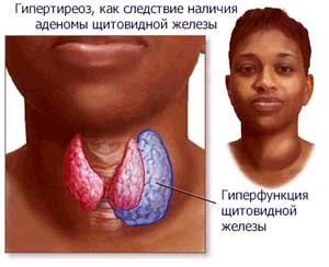 Аденома щитовидной железы как причина тиреотоксикоза