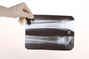 Рентген вывих колена