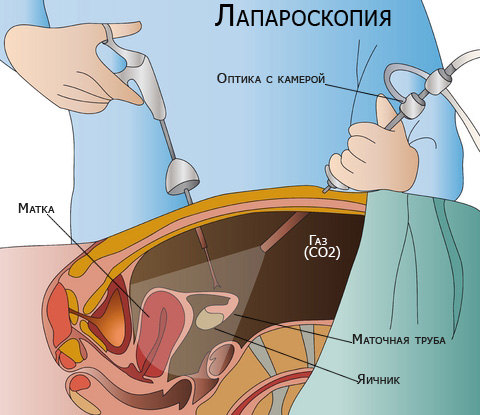 Лапароскопия при аднексите
