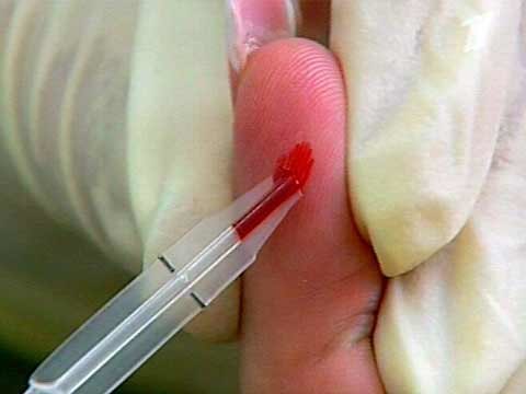 Анализ крови на вирус краснухи
