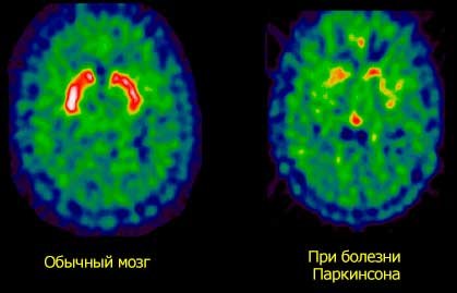 Изменения в головном мозге при болезни паркинсона