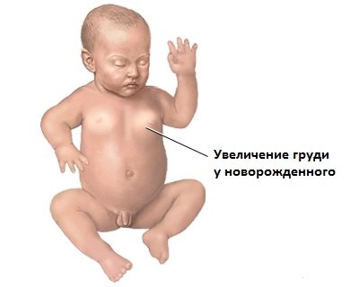 Гинекомастия младенца
