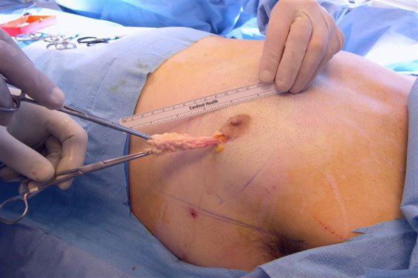 Хирургическое лечение гинекомастии