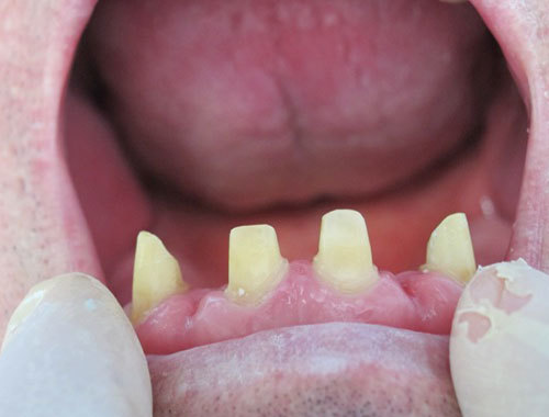 adentija-vrozhdennoe-otsutstvie-zuba-4