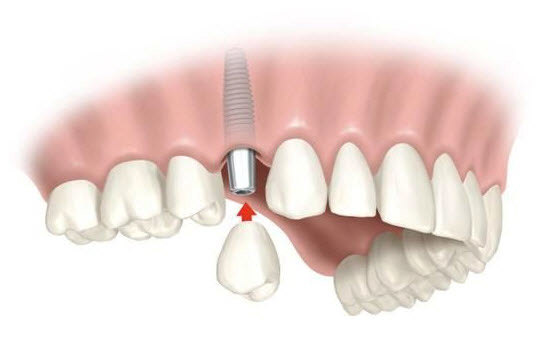 adentija-vrozhdennoe-otsutstvie-zuba-7