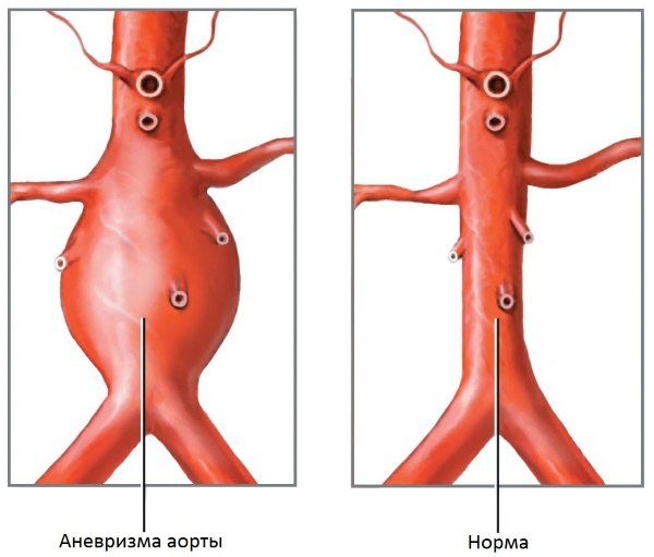 anevrizma-aortyi-bryushnoy-polosti_405