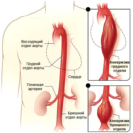 anevrisma-aorti