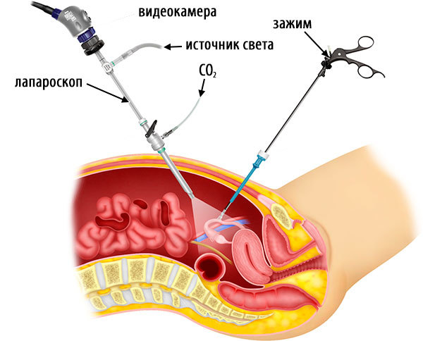 laparoskopiya