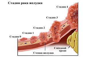 stadii-raka-jelydka47