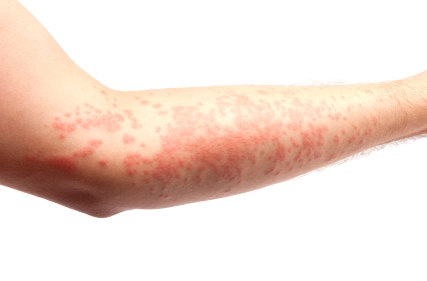arm covered in a skin allergy,hives