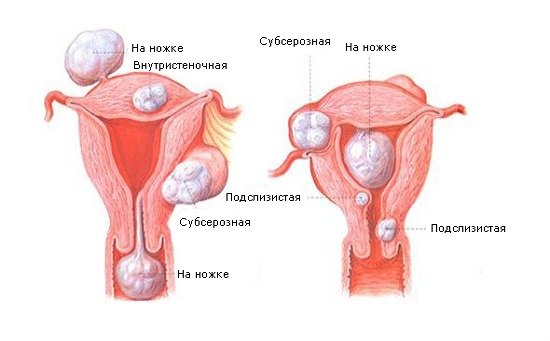 Виды фибромы матки