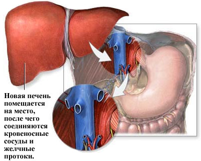 liver-t6