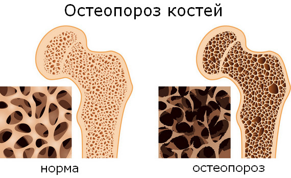 остеопороз при болезни Иценко-Кушинга